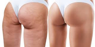 Cellulite